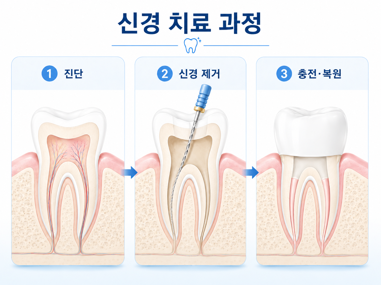 신경치료 설명 이미지