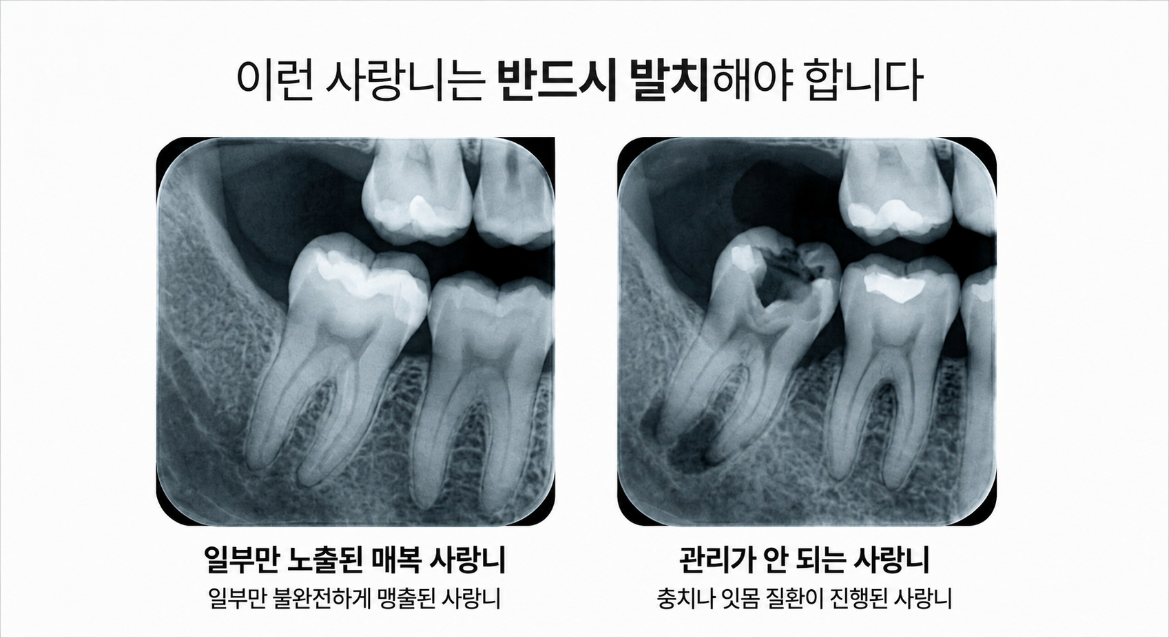 사랑니 발치 진단 이미지