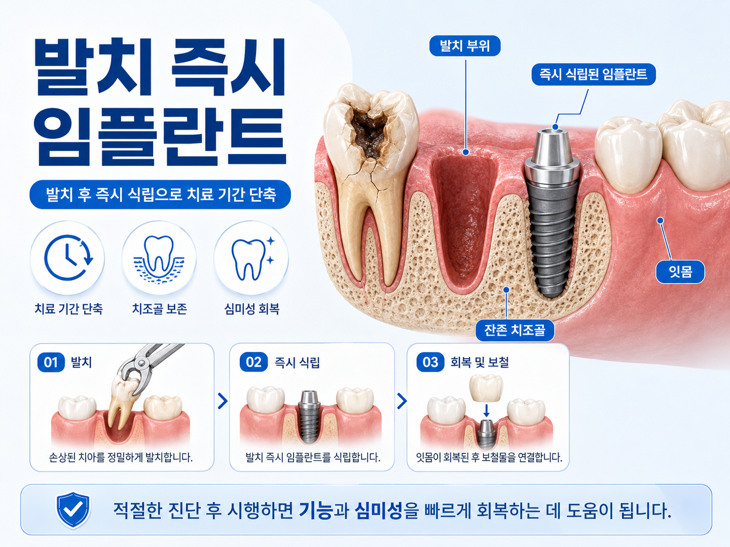 발치 즉시 임플란트 설명 이미지