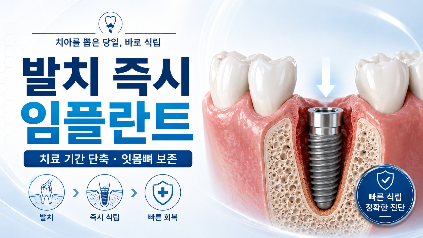 발치 즉시 임플란트 상담 안내