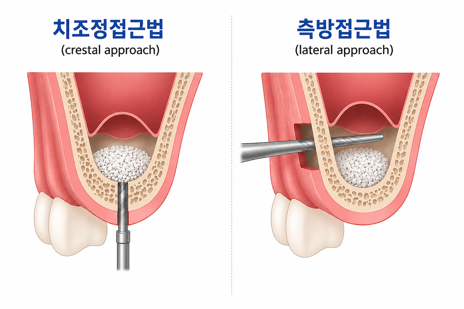 치조정접근법과 측방접근법 비교 설명 이미지
