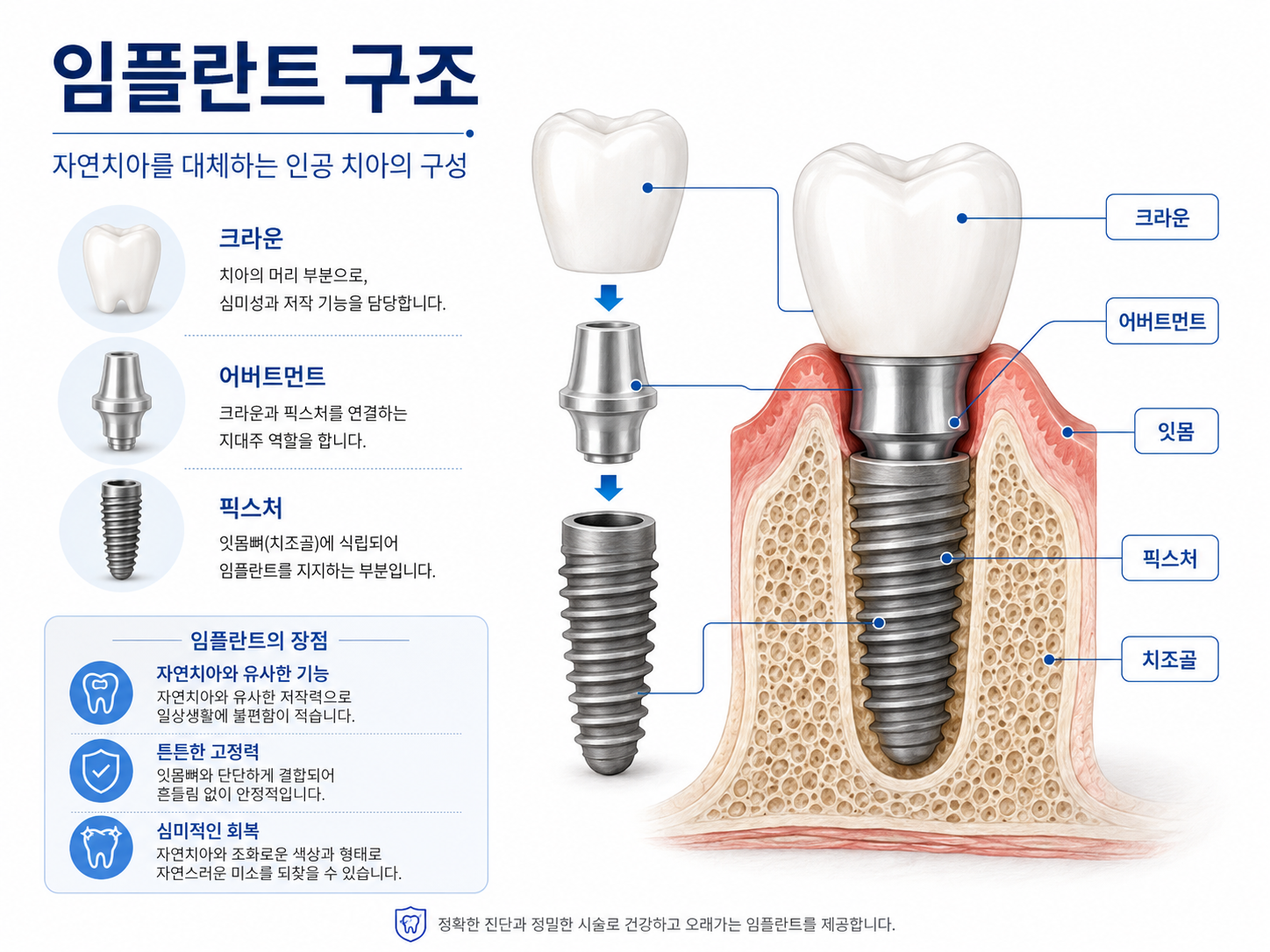 임플란트 구조: 인공치근, 지대주, 크라운