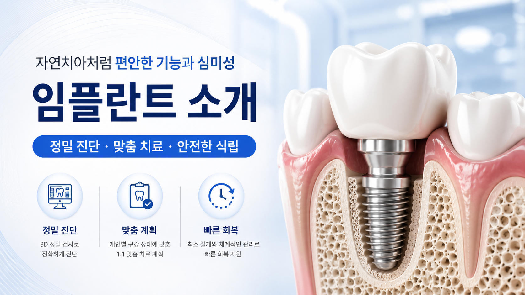 임플란트